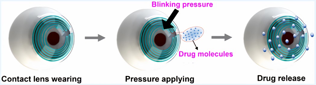 Schematic illustration of drug release process realized by contact lens.